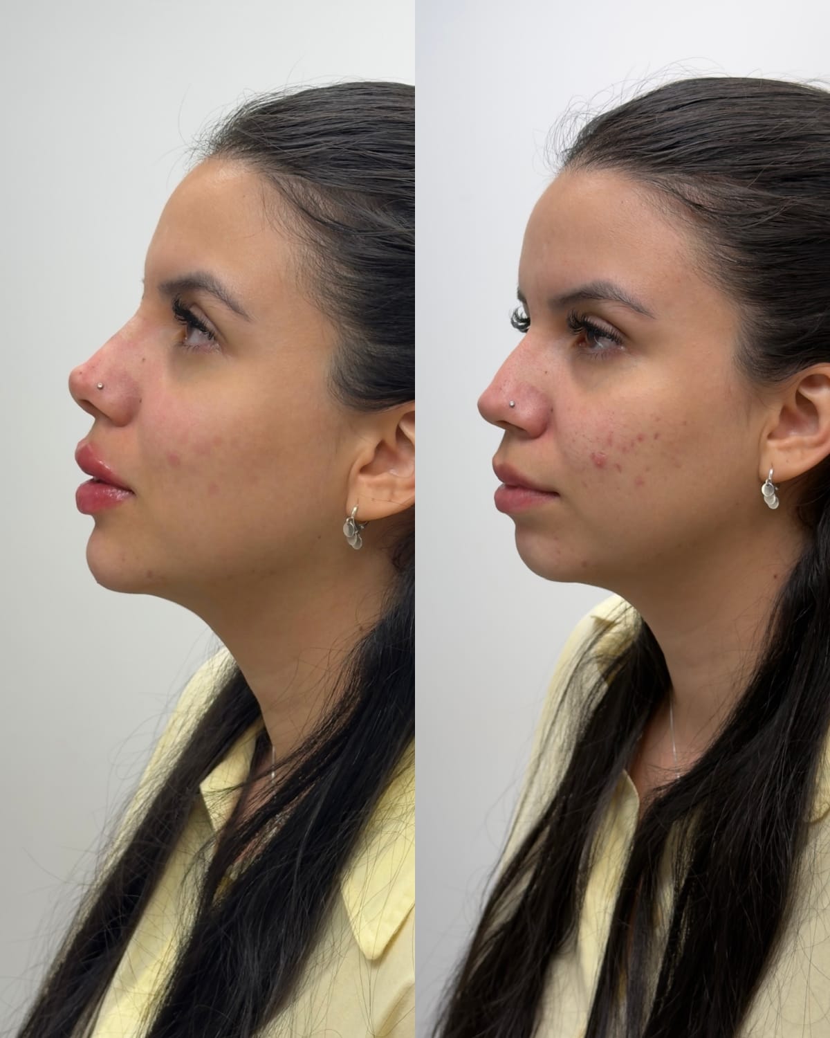 Comparativo de perfil facial antes e depois do tratamento